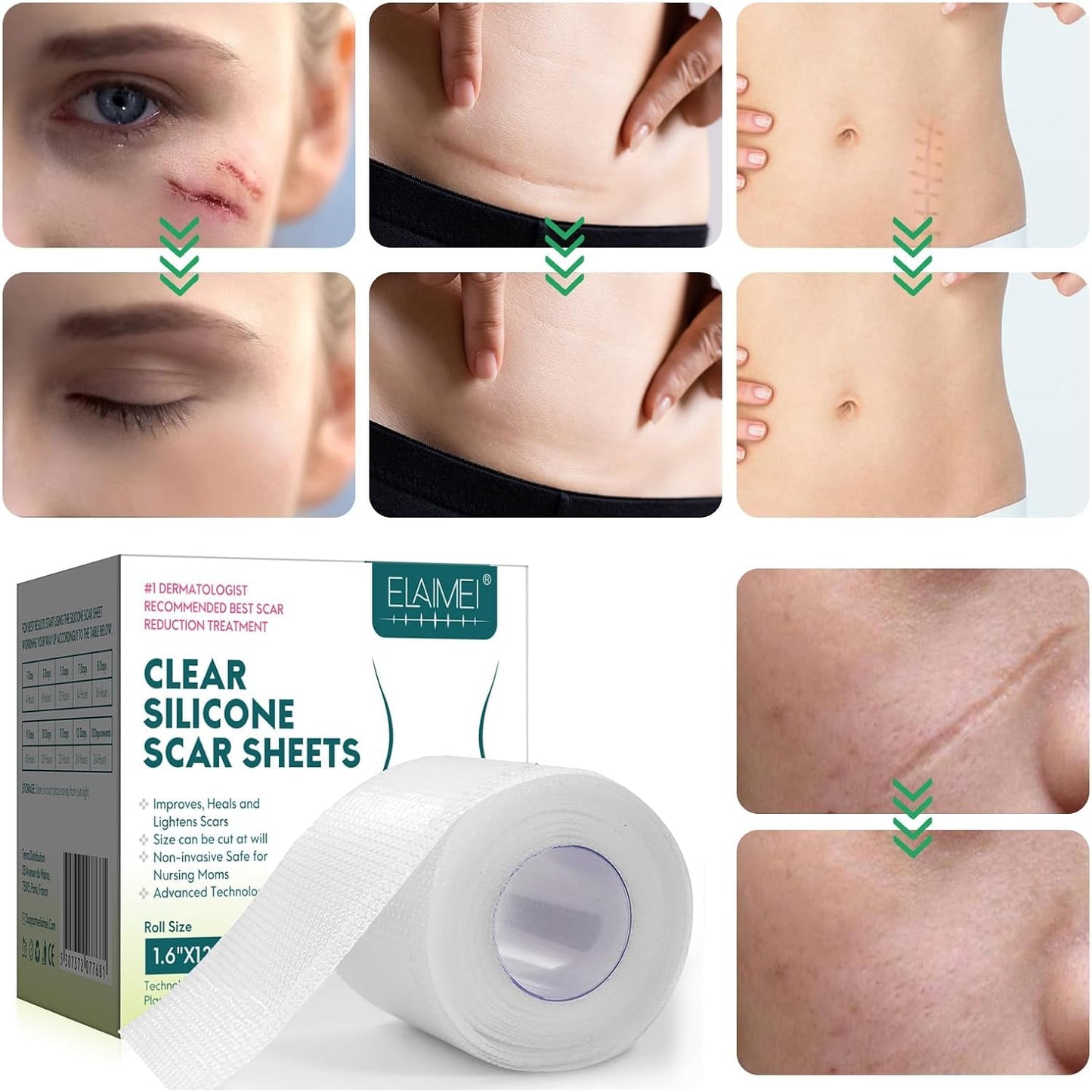 Clear Silicone Scar Sheets, Scar Away Scar Tape,