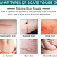 Silicone Scar Sheets (1.6” x 120”Roll-3M)