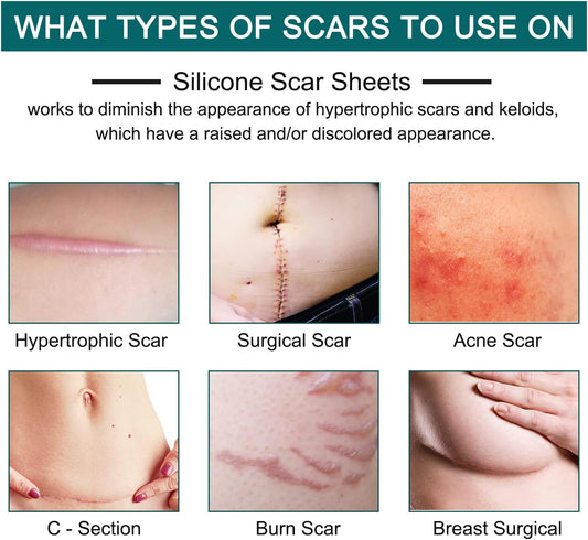 Silicone Scar Sheets (1.6” x 120”Roll-3M)
