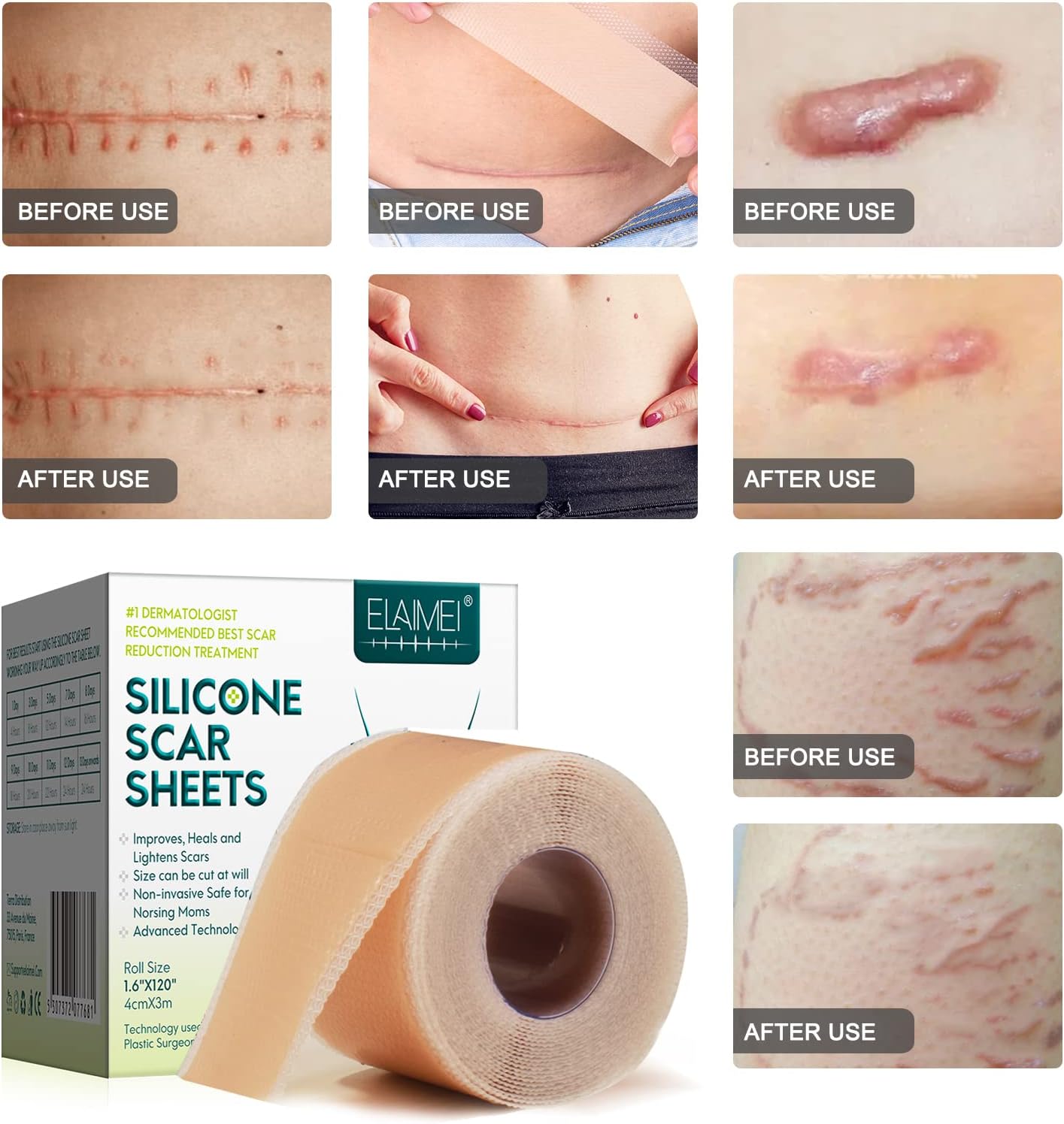 Silicone Scar Sheets (1.6” x 120”Roll-3M)
