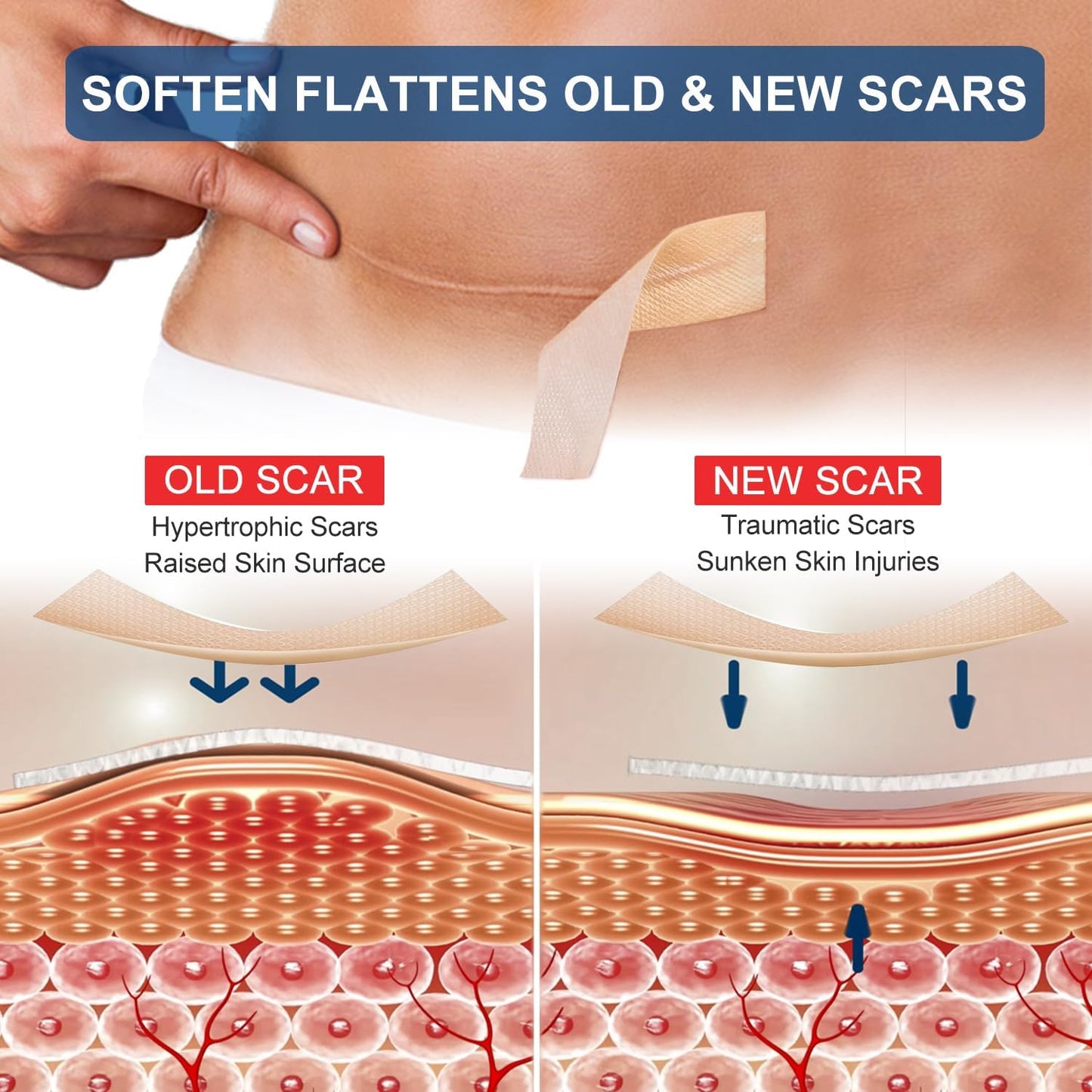 Silicone Scar Sheets (1.6” x 120”Roll-3M)