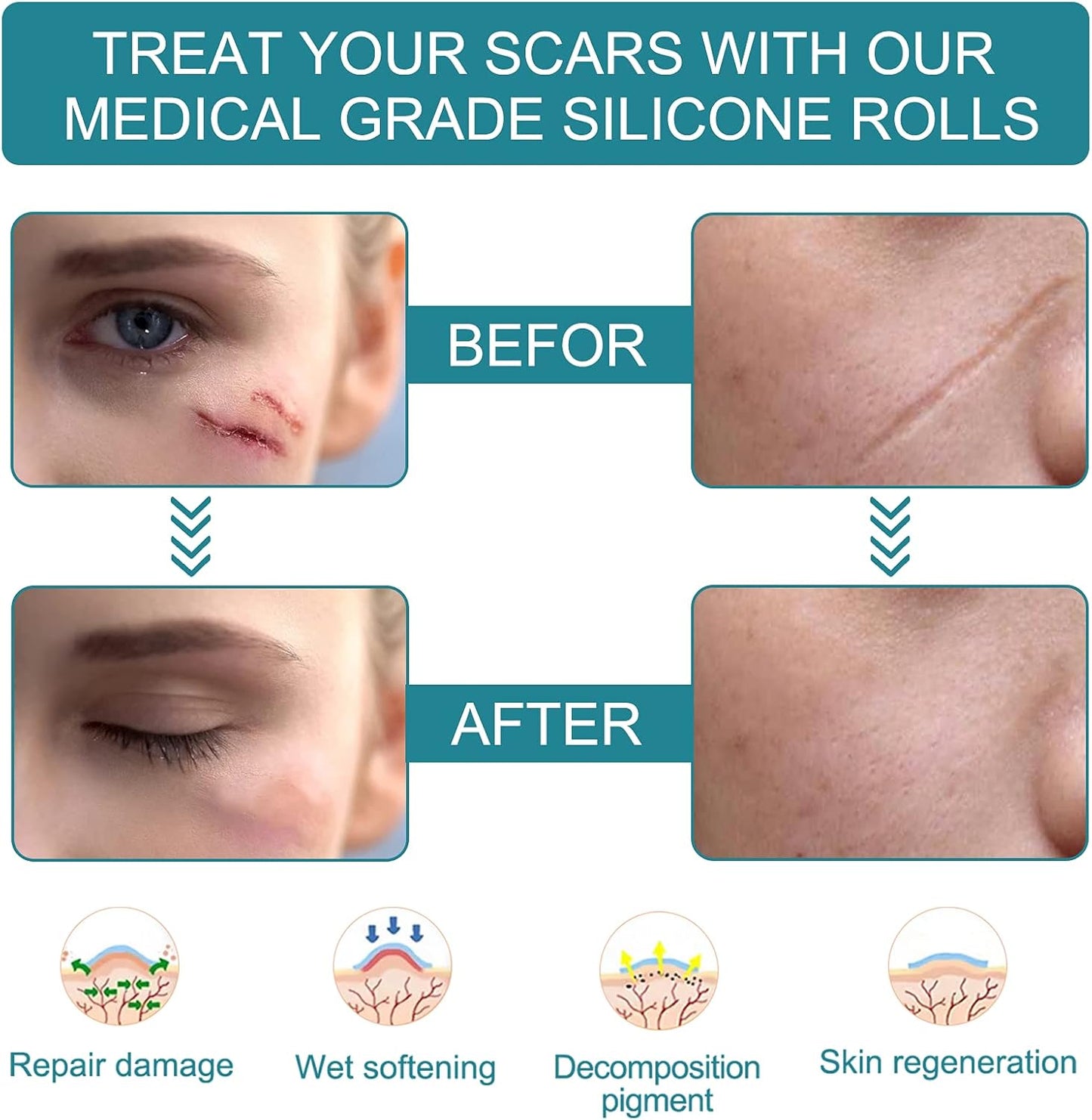 ZODENIS Medical Grade Silicone Scar Sheets, Silicone Scar Tape (1.6”x 60”)